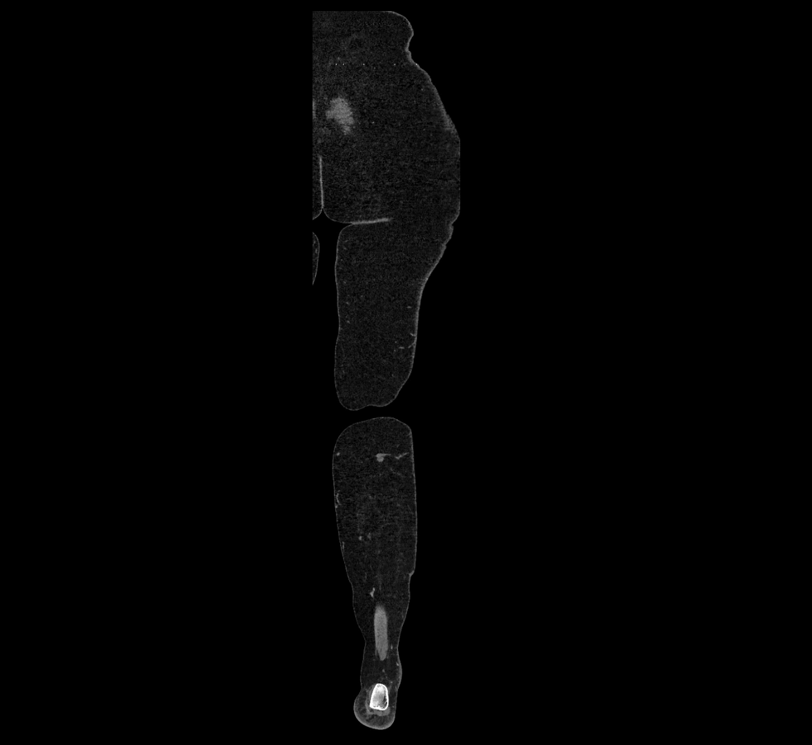 CTA lower limb coronal cross sectional anatomy labelled image _86 (2).webp
